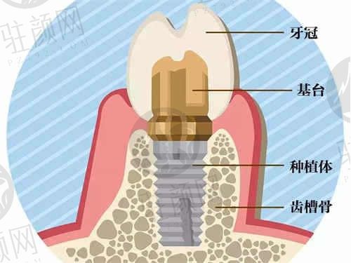 上海正睿口腔医院种植牙价格表,3000元起!刘定斌医生20年口腔种植经验