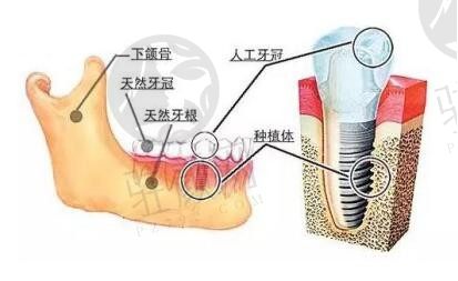 成都种植牙多少钱一颗2024年？极光3880+新桥3480+布莱梅联合5800+