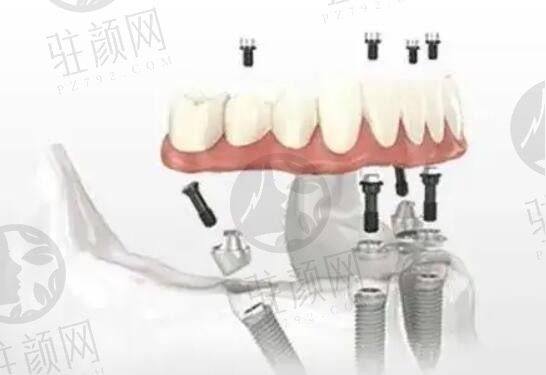 北京全口种植牙真实报价（正文含便宜又好的种牙医院排名榜前十）