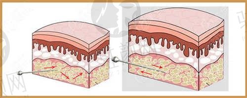 西安高一生美容医院抽脂怎么样？贵不贵？陈伟院长科学抽脂只需1w起！