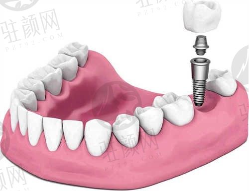昆明美奥口腔医院种植牙贵不贵?价格优惠能刷医保!韩国登腾一颗2980元还加烤瓷冠!