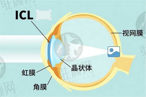 昆明华厦眼科医院ICL晶体植入手术价格公开:晶体植入28000元起,点击了解其他项目价格