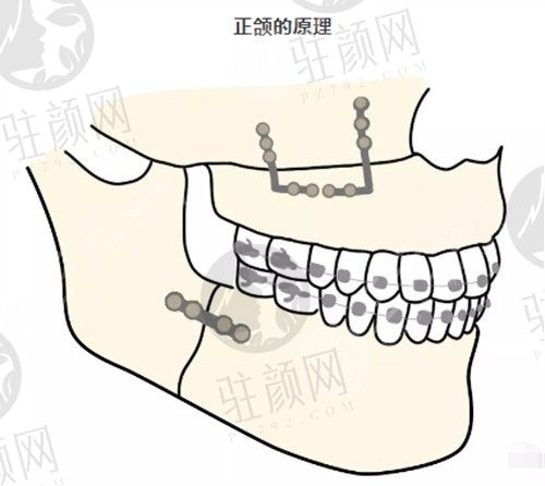 上海时光整形正颌手术多少钱?何晋龙医生正颌矫正技术好还不贵