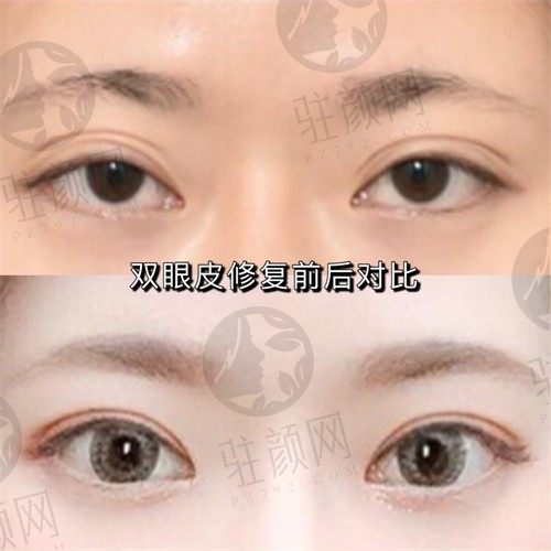 上海爱尚丽格眼修复价格40000元起,内外眼角/双眼皮修复技术水平高