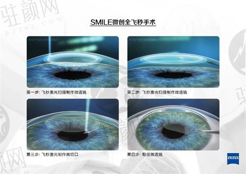 广州视献眼科医院价格贵吗，不贵，飞秒1.2W/晶体3.5W，可在线预约高月院长