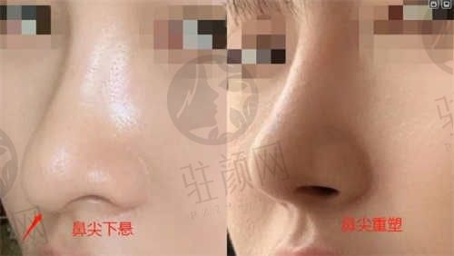 郴州唯美医疗美容欧阳春医生隆鼻手术18000元起，技术真的很不错呢