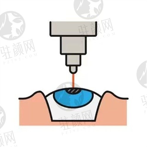 东莞爱尔眼科叶健章医生白内障手术价格:9900元起、靠谱不贵