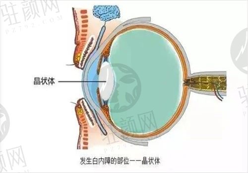 通化爱尔眼科医院高冬梅白内障手术3990起，超声乳化+人工晶体让您放心