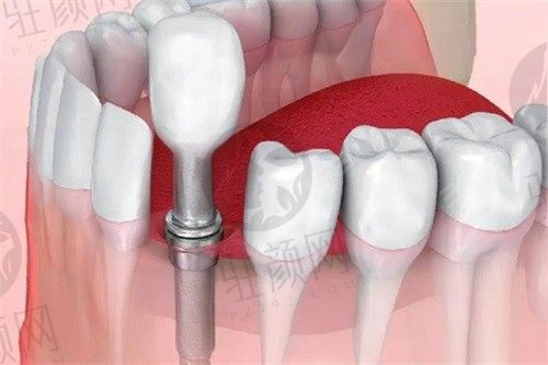  武汉华硕口腔医院车超医生做德国ICX种植体，价格8900元/颗种植稳定