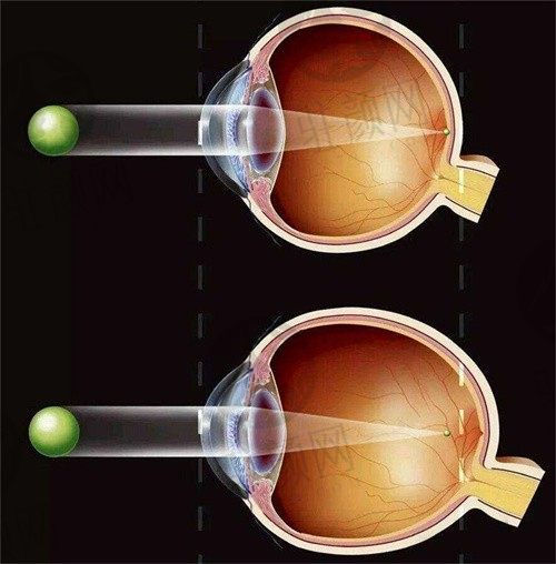 南京维视眼科CL晶体植入手术暑期优惠火热进行中，价格低至26800元！