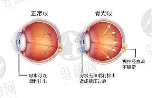 兰州普瑞眼科医院刘永民青光眼手术6000元起，一键解决眼睛模糊问题