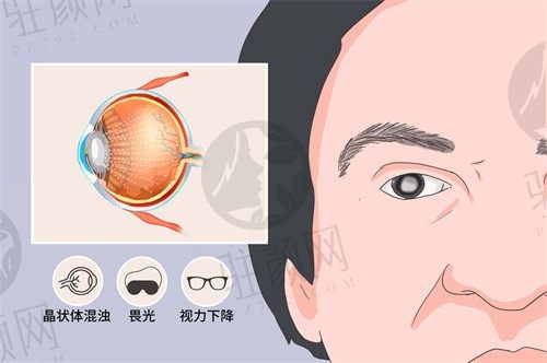 北京宁联西海眼科王宁利常规角膜塑形镜6400元起，改善近效果挺好