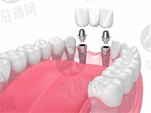 重庆美奥口腔医院王凯韩国进口种植牙3900元起，做过的患者都说好