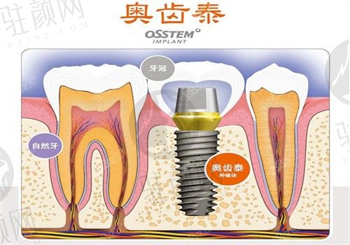 杭州修元口腔医院赵志楞奥齿泰种植牙3500/颗，价格优惠地址电话价格表全都有