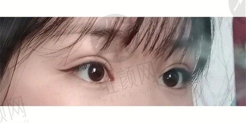  北京客来美舍医疗美容门诊部张冰洁眼袋修复3w元起，效果真的好