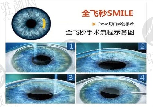 乌鲁木齐美尼康眼科医院易湘龙全飞秒18000元起，还你清晰视界