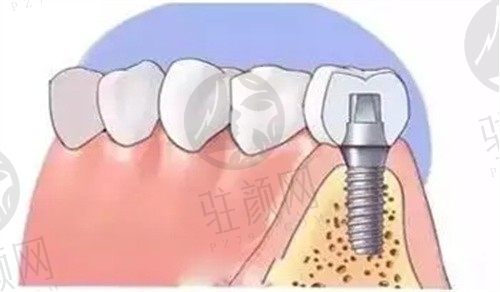 深圳港龙医院口腔科陈思韩登腾种植牙2680元起，价格实惠效果好