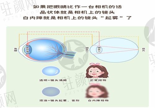 银川进川眼科医院白内障手术费用分享：人工晶体仅需4000元，童亮医生主刀