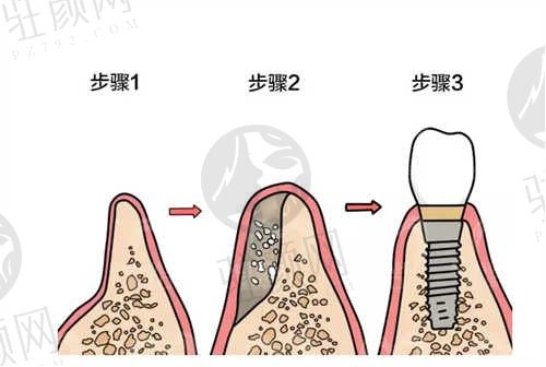 重庆种植牙哪些医院便宜技术好？重庆团员口腔/牙博士/维乐口腔等口腔医院上榜！