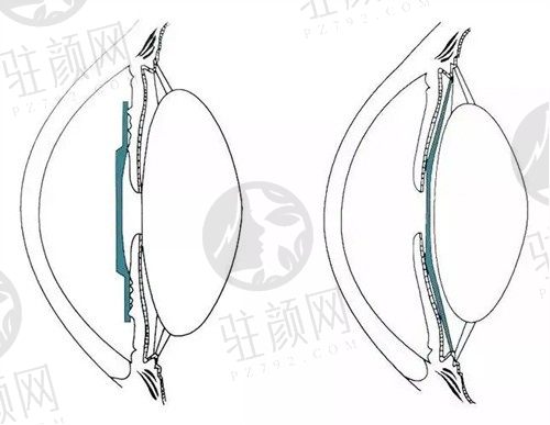 合肥普瑞眼科医院怎么预约挂号?网上预约方式及医院电话分享