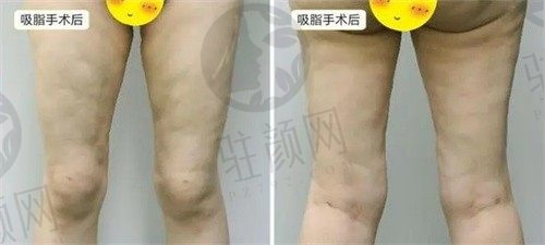 深圳鹏程医院贾征然大腿内侧吸脂8000元起，术后效果自然美观