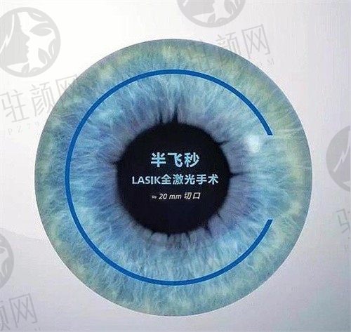 广州佰视佳眼科医院陈军做半飞秒价格14600元起，医生技术很放心