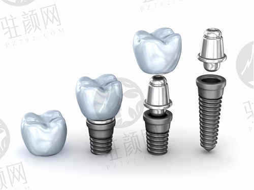 上海正睿口腔医院种植牙价格表