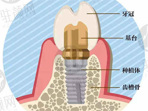 上海正睿口腔医院种植牙价格表