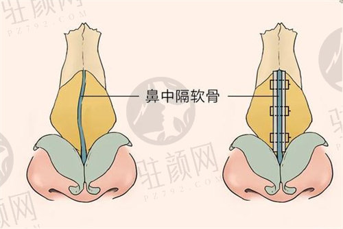 上海王艳医生做鼻子怎么样