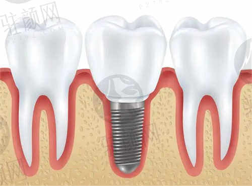西安贝尔口腔医院种植牙价格表一览 费用真的贵吗?