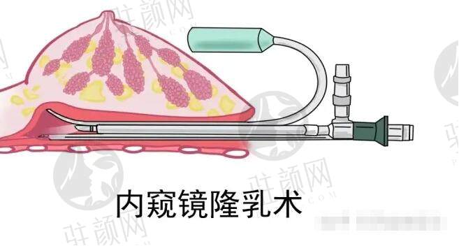 栗勇缩胸到底怎么样