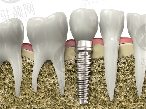 杭州雅莱口腔医院种植牙价格多少钱一颗