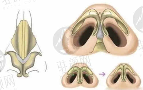 西安画美整形医院隆鼻