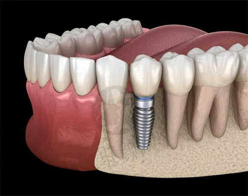 徐州医大鼎植口腔种植牙