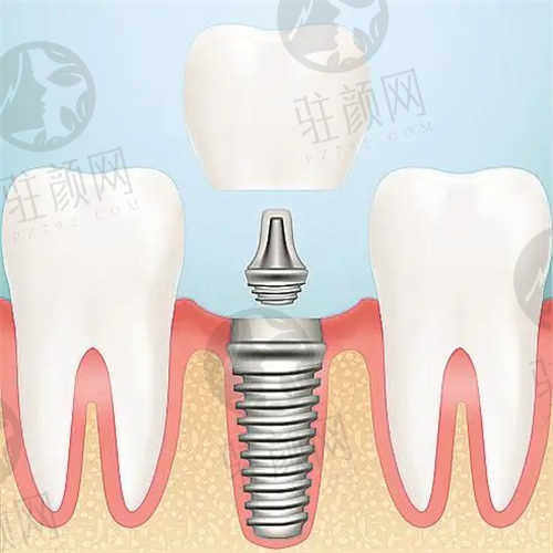 福州登特口腔医院种植牙价格
