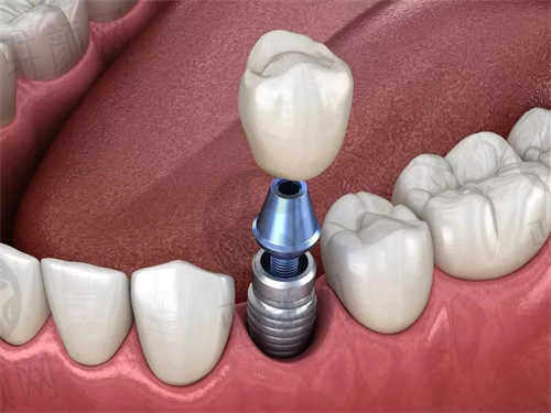 西安团圆口腔医院种植牙
