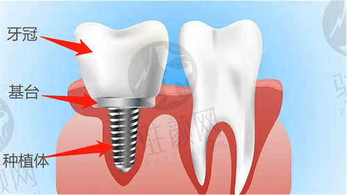 西安天皓口腔医院2024种植牙价格公开：韩系奥齿泰、瑞士ITI等价格都在这了