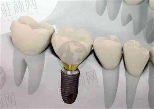 西安天皓口腔医院2024种植牙价格公开：韩系奥齿泰、瑞士ITI等价格都在这了