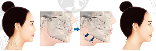 重庆松山医院颌角整形手术价格