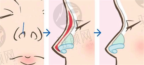 北京画美医疗美容医院鼻整形手术价格