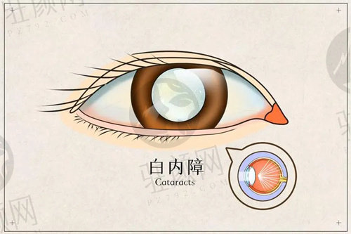 合肥普瑞医院白内障手术价格