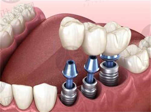 上饶口腔医院种植牙价格