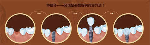 福州美可普口腔医院种植牙
