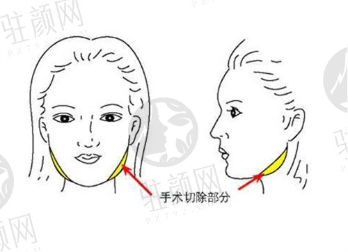 潍坊医学院整形外科医院颌面整形价格