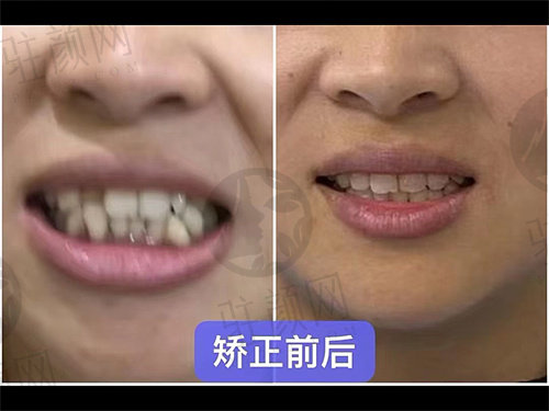 上海曙康口腔医院牙齿矫正成功病例