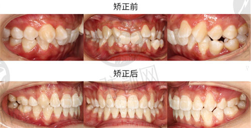 上海曙康口腔医院牙齿矫正成功病例