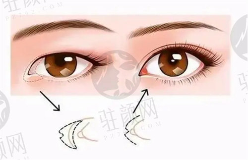 上海爱尚丽格医疗美容门诊部眼部修复手术价格