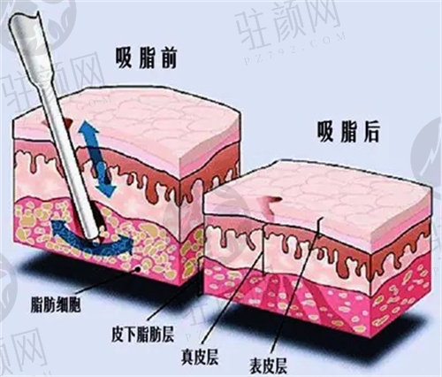 重庆松山医院抽脂手术医生