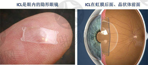南宁华厦眼科医院ICL晶体植入示意图