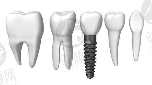 齐齐哈尔牙博士口腔医院种植牙
